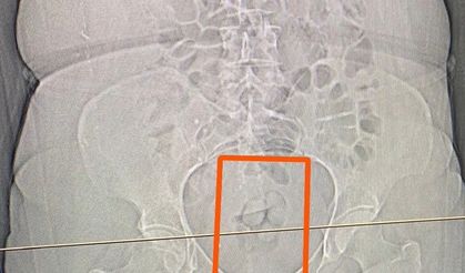 Midesinden 21,39 gram uyuşturucu çıktı